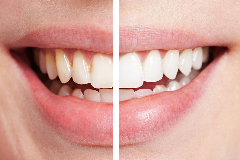 ฟอกสีฟันแบบไหนตรงใจคุณที่สุด